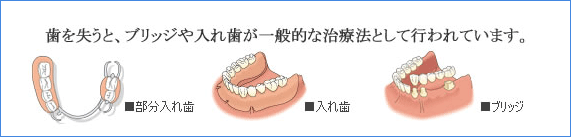 歯を失うと、ブリッジや入れ歯が一般的な治療法として行われています。